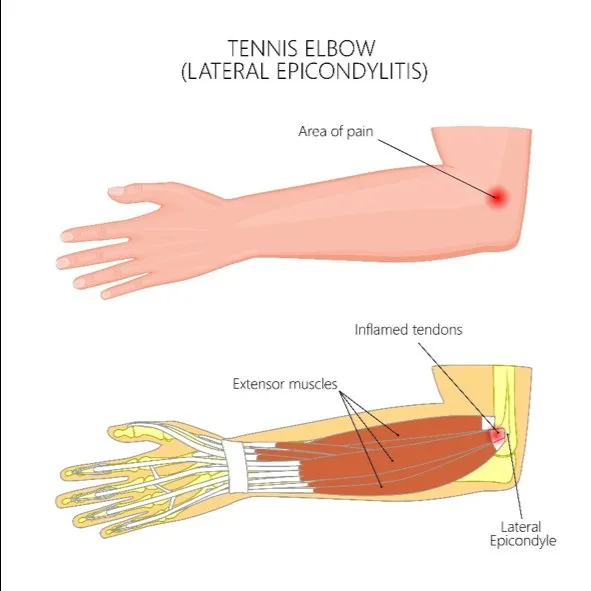 Diagram of tennis elbow: the area of pain and inflamed extensor tendons at the lateral epicondyle